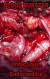 ouvir online Blood Burster - Infectious Endocarditis